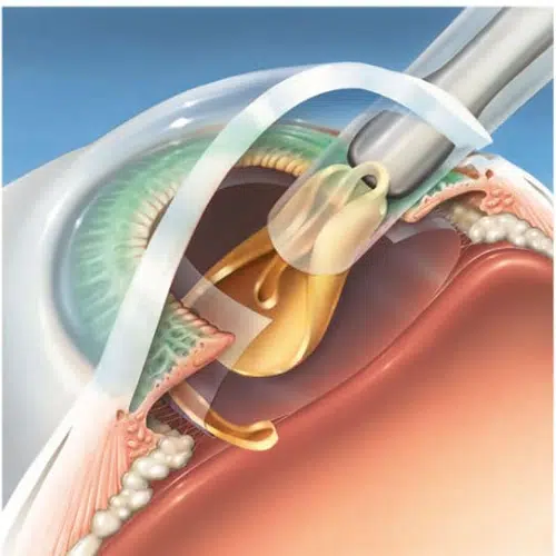 人工晶體植入過程示意圖